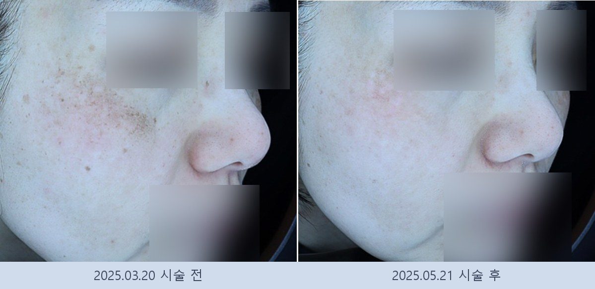 기미 잡티